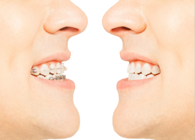 Invisalign Provider