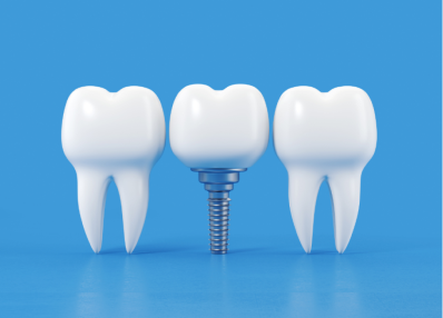 Missing tooth? Opt for Dental Implant